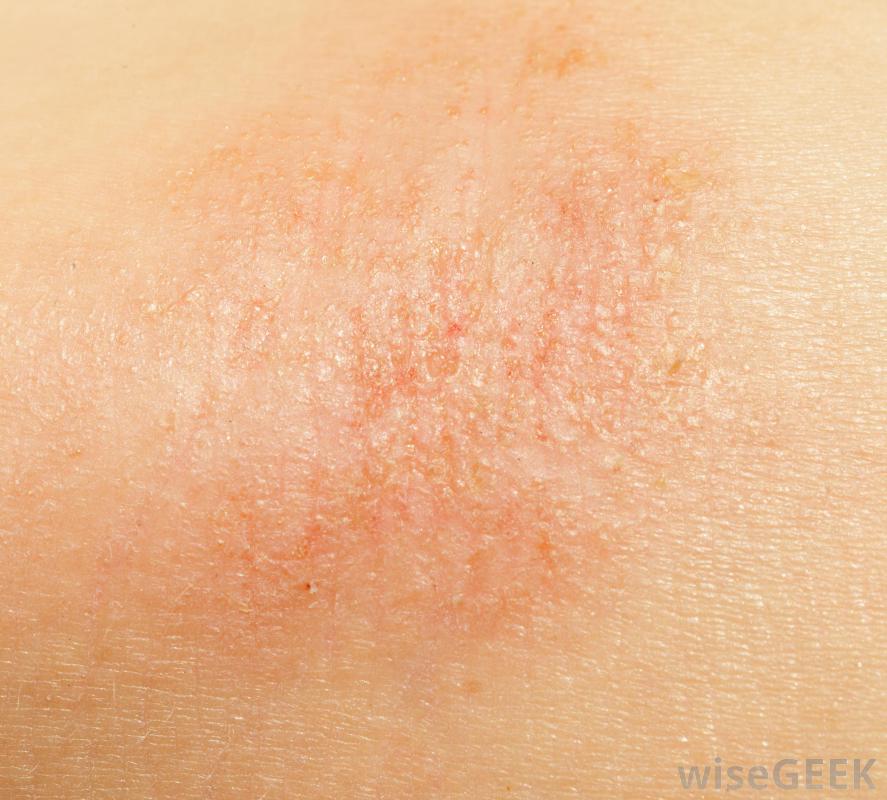Dry Spots On Skin Body
